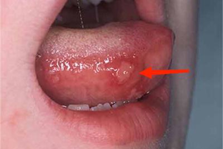 手足口病舌侧有一大块溃疡图