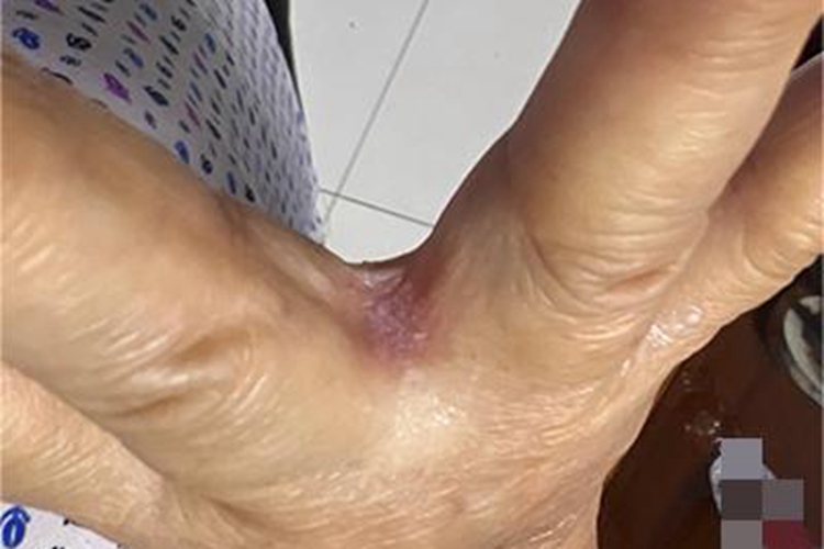 间擦疹手指缝症状图