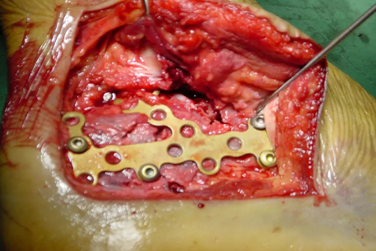 跟骨骨折内固定取出术图
