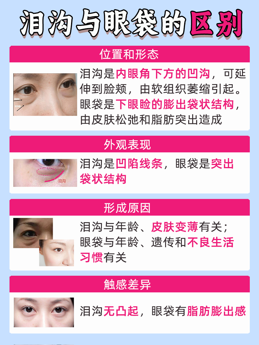 泪沟与眼袋的区别图
