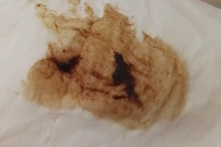 自发性早产褐色分泌物图