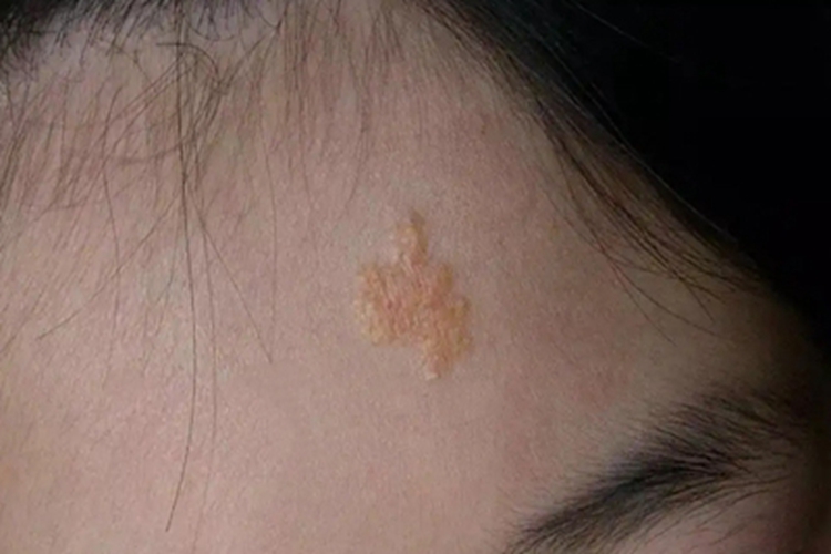 皮脂腺上皮瘤斑图