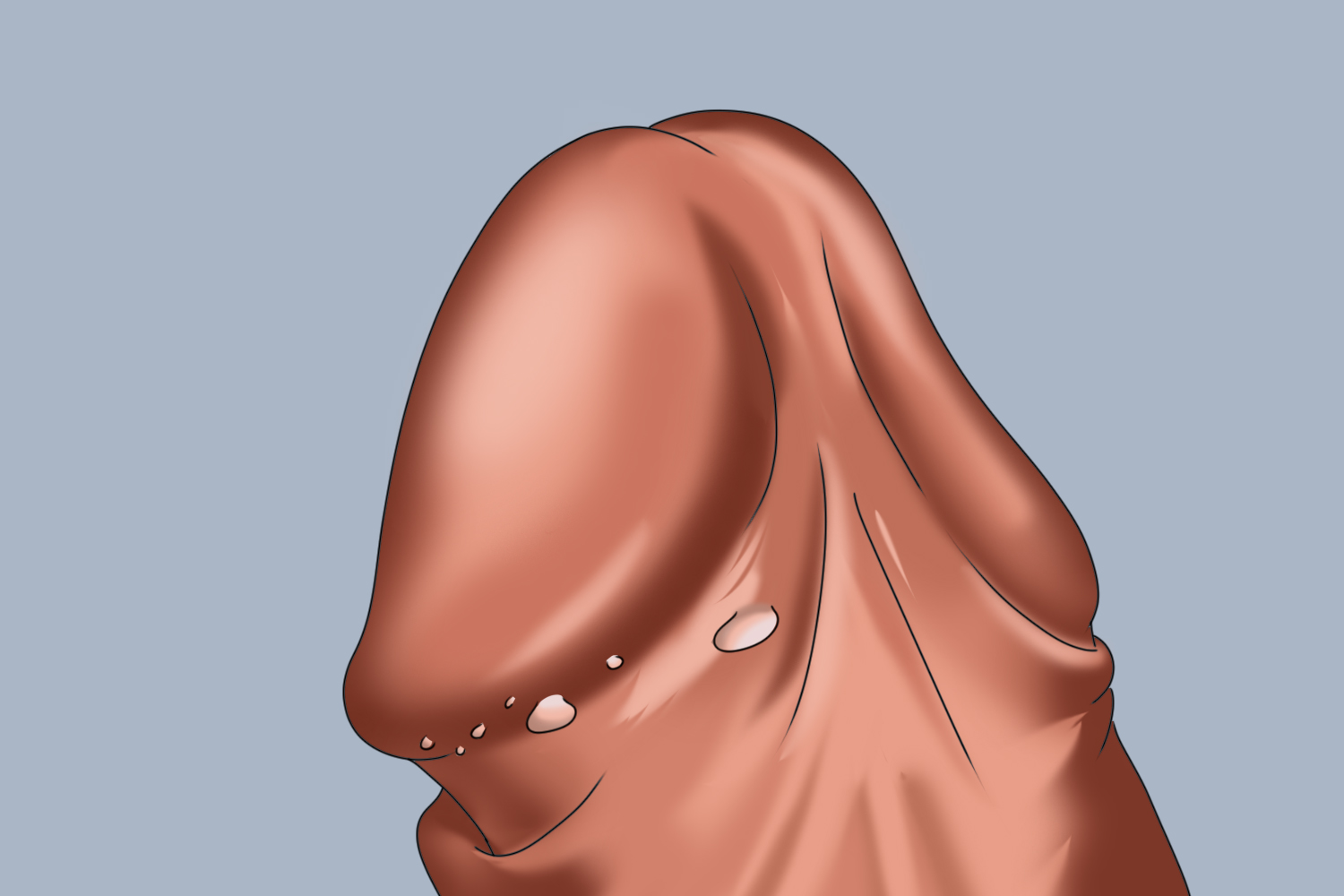 尖锐湿疣早期手绘图