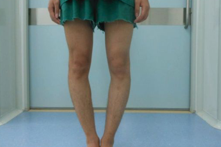 O型腿示意图