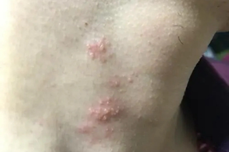 柯萨奇病毒疹颈部小水疱图
