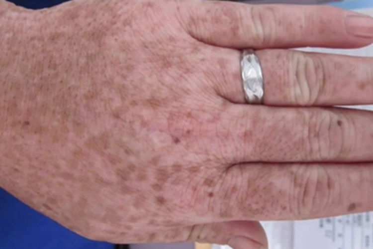 网状肢端色素沉着症状图 网状肢端色素沉着症状图