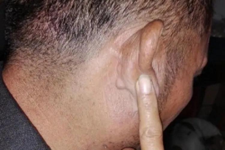 浅表性皮肤脂肪瘤痣耳后结节图