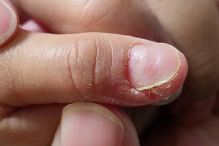 咬甲癖手指甲变形图 咬甲癖手指甲变形图