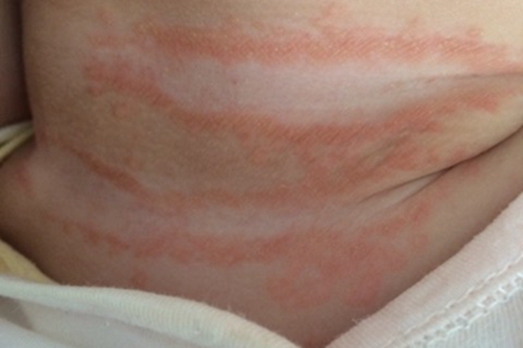 渗出型婴儿湿疹颈部红斑图