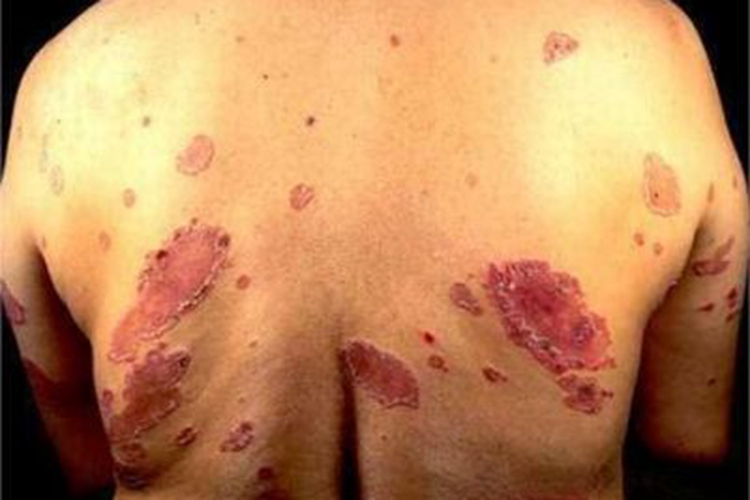 线状IgA大疱性皮肤病背部结痂图 线状IgA大疱性皮肤病背部结痂图