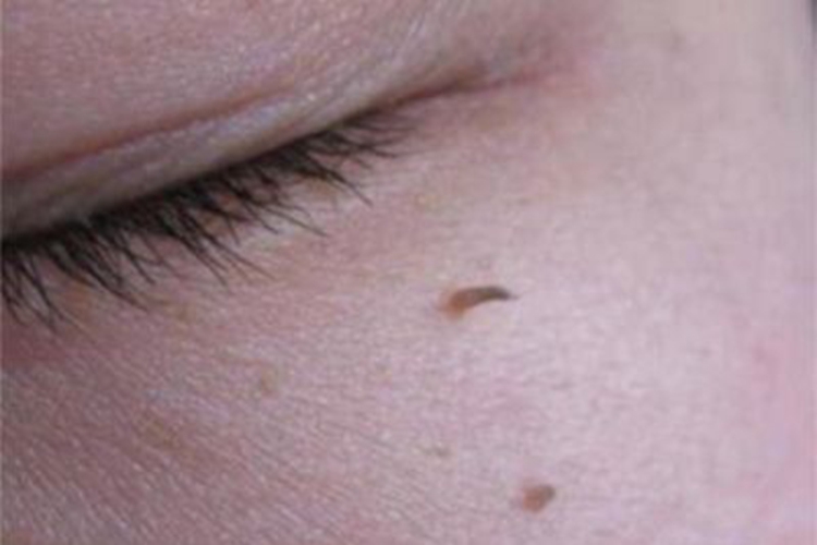 寻常疣眼周长细小肉粒图 寻常疣眼周长细小肉粒图