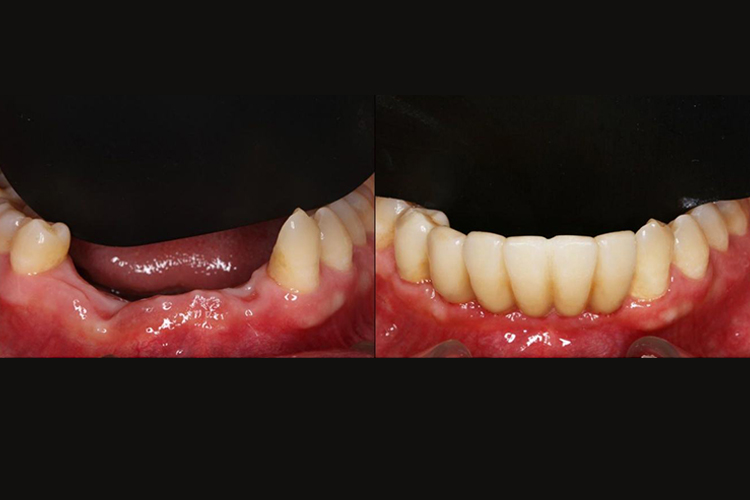 多颗下牙种植牙效果图 多颗下牙种植牙效果图
