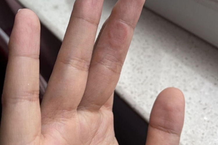 环状肉芽肿手指症状图