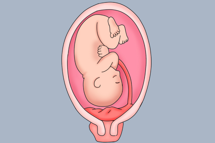 完全性前置胎盘图