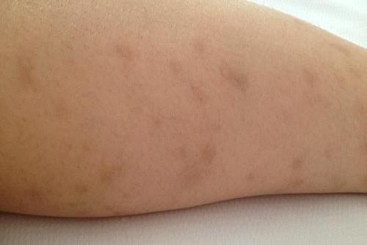 湿疹留下的疤痕图