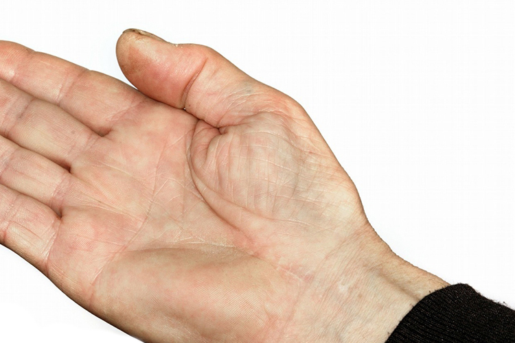 手掌肌肉萎缩图