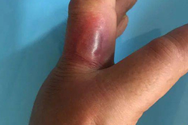 局限型类丹毒手指缝水疱图