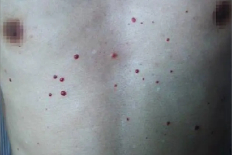 樱桃状血管瘤胸部疙瘩图 樱桃状血管瘤胸部疙瘩图