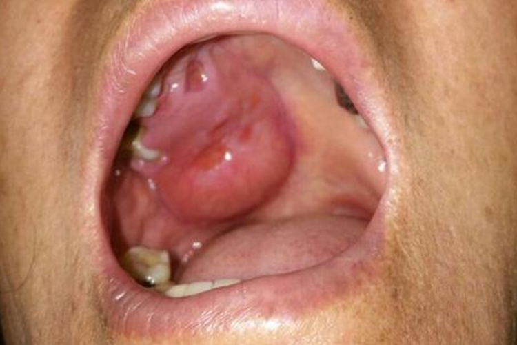 三期梅毒口腔梅毒性树胶肿图