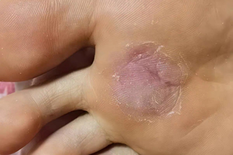 寻常疣脚底紫斑图 寻常疣脚底紫斑图