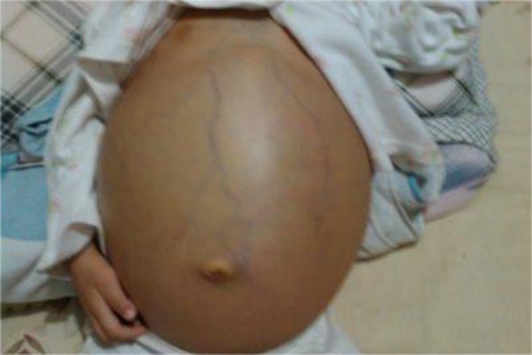 肠梗阻所致肚子圆鼓鼓图 肠梗阻所致肚子圆鼓鼓图