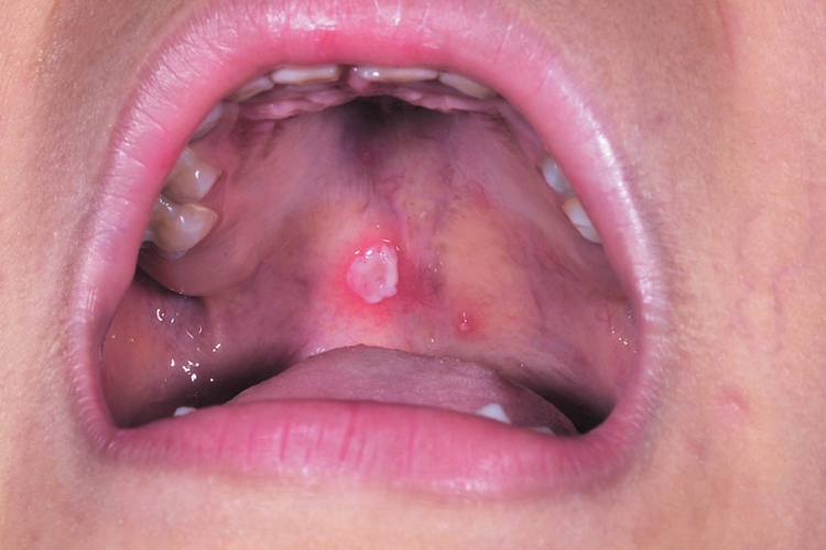 手足口病初期口腔疱疹图
