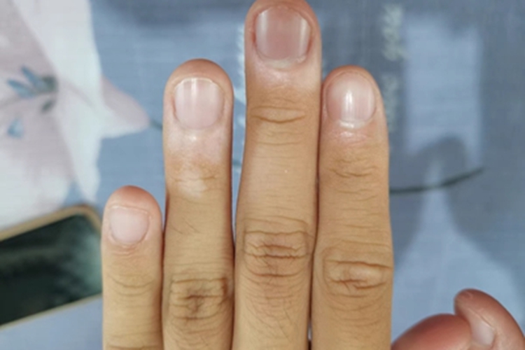 面肢端型白癜风手指白斑图