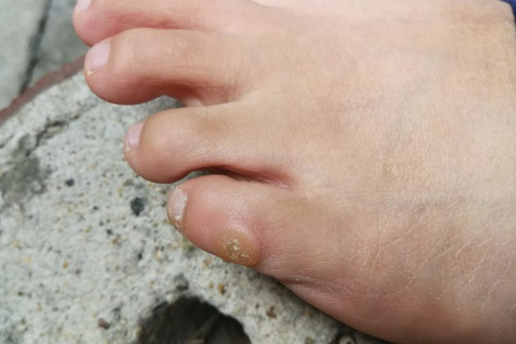 小脚趾外侧腱鞘囊肿图