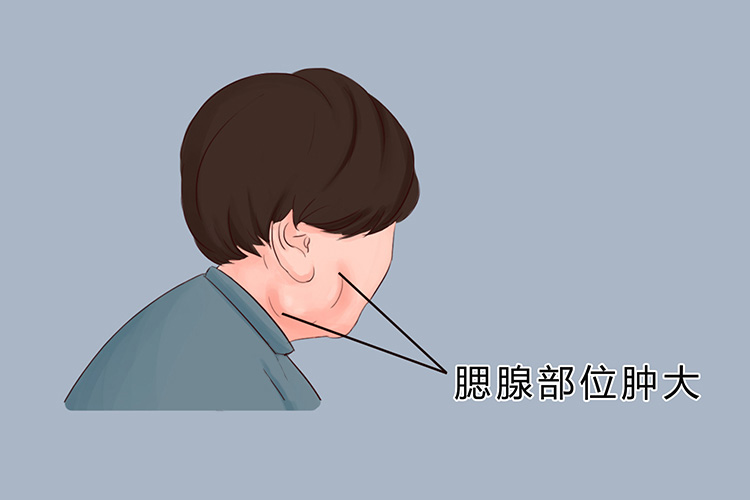 腮腺肿大图