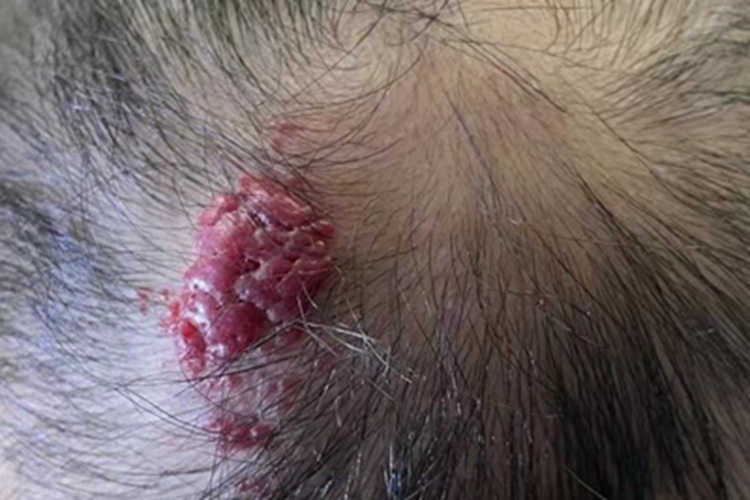 浅表型婴儿血管瘤头皮症状图