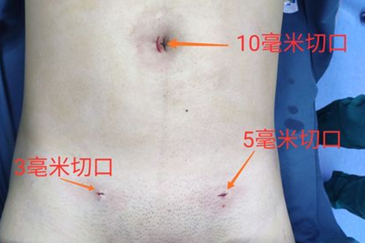 肚脐部位开刀图 肚脐部位开刀图