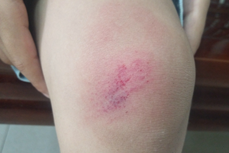 撞伤膝盖皮肤红肿淤血图