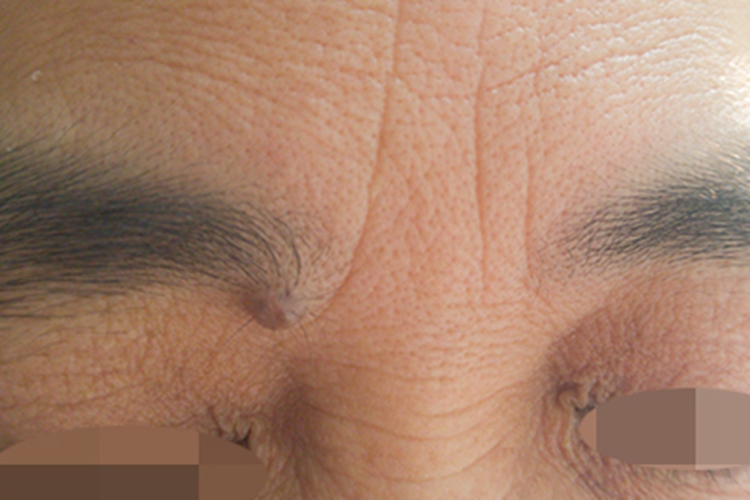 黑素细胞痣眉毛疙瘩图