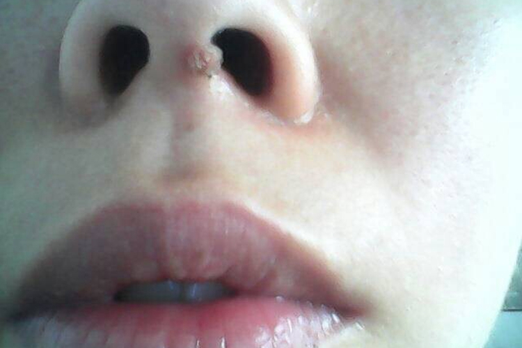 鼻孔口寻常疣图