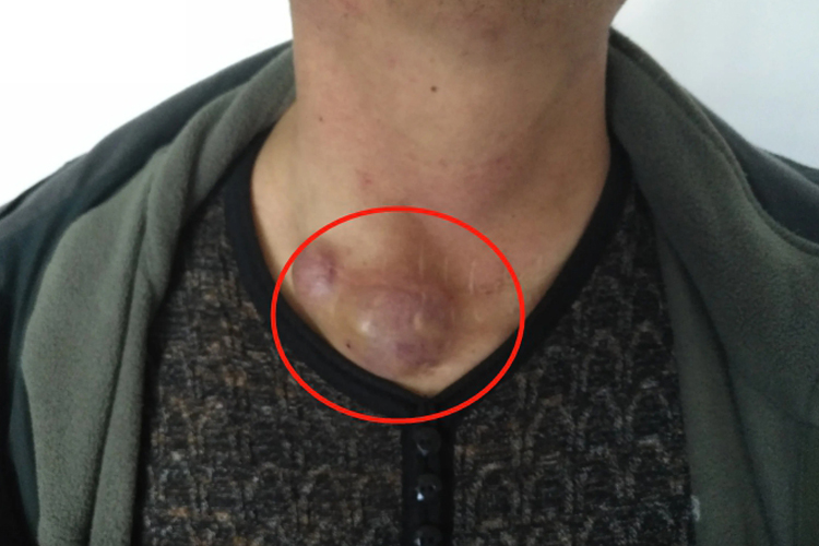 甲状腺术后伤口形成瘢痕图