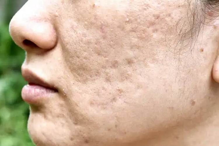 凹陷性痤疮瘢痕图