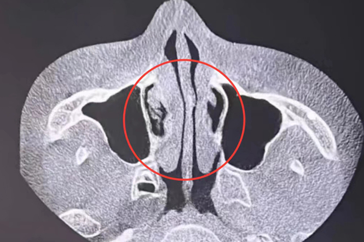 慢性肥厚性鼻炎CT图
