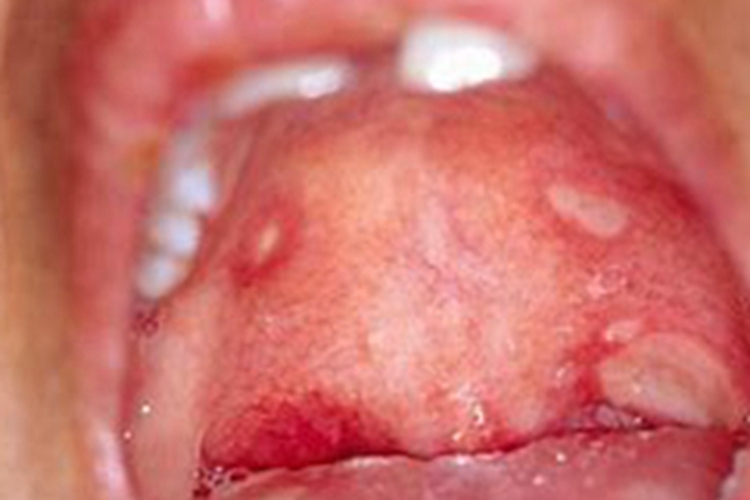 白塞病口腔症状图 白塞病口腔症状图