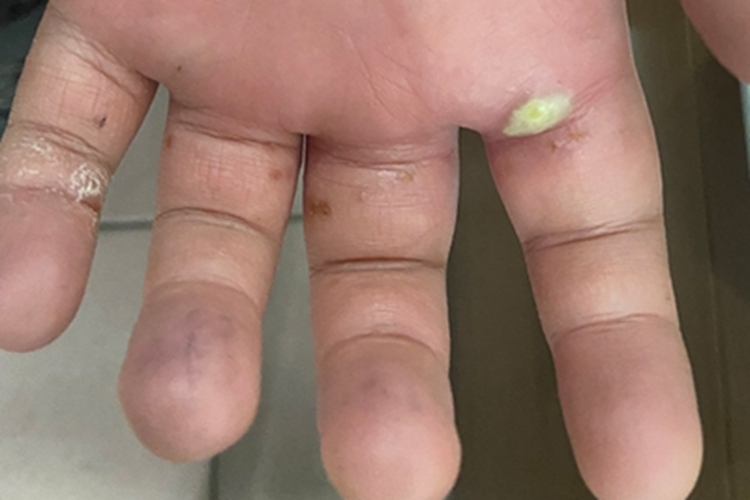 非大疱型脓疱疮手掌脓包图