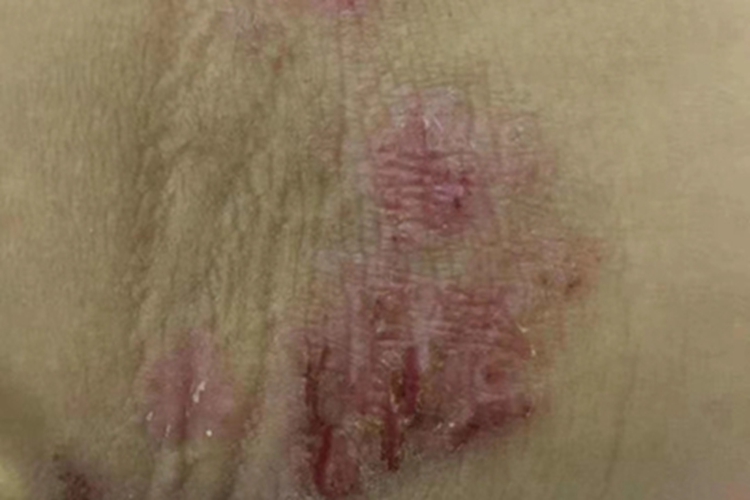 青年成人期特应性皮炎肘窝血痂图 青年成人期特应性皮炎肘窝血痂图