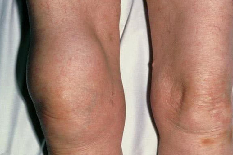 膝盖肿一个大包图