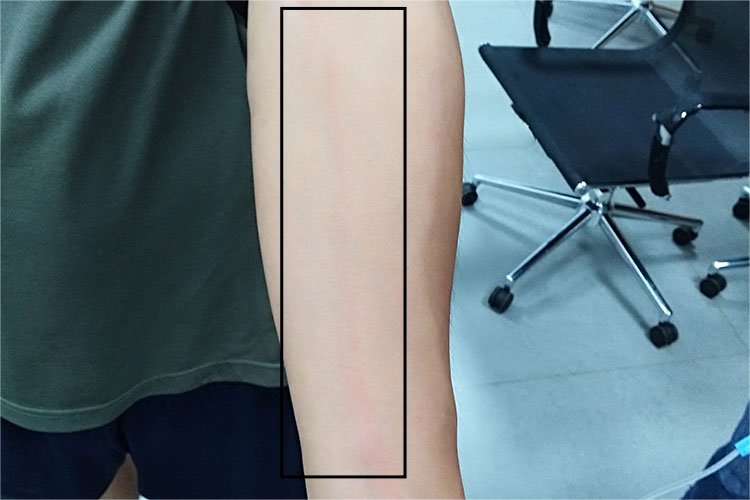 手臂静脉炎条索样发红图