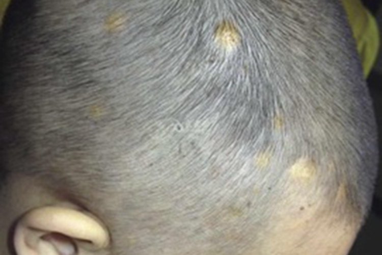 幼年黄色肉芽肿头皮症状图