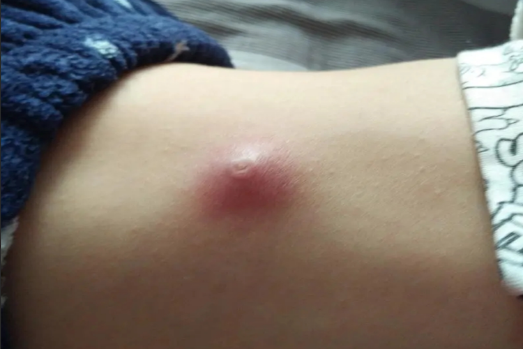 儿童毛囊炎症状和图片 儿童毛囊炎症状和图片