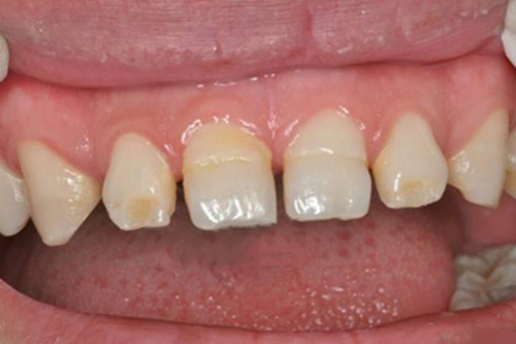 牙釉质发育不全牙齿条纹图 牙釉质发育不全牙齿条纹图