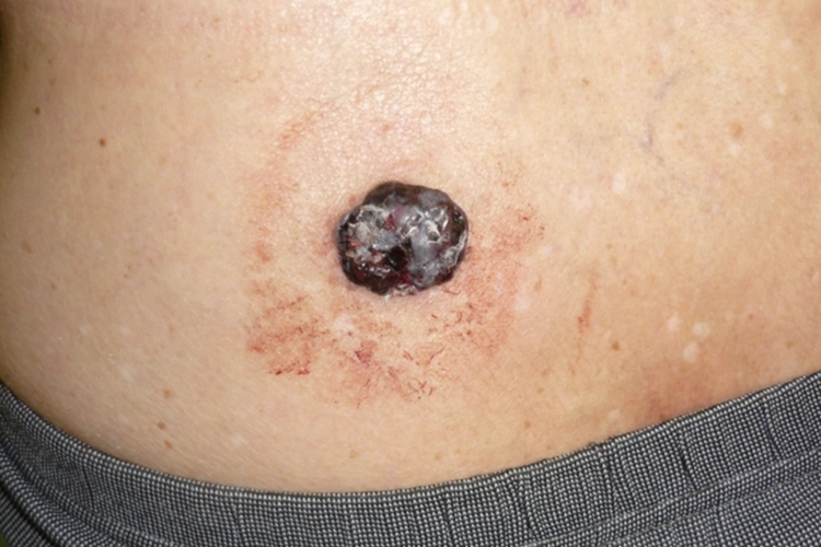 腰部恶性痣图