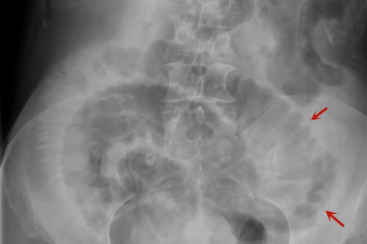 肠梗阻X线鱼肋骨刺状图