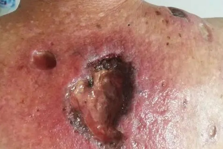 溃疡型坏疽性脓皮病背部症状图
