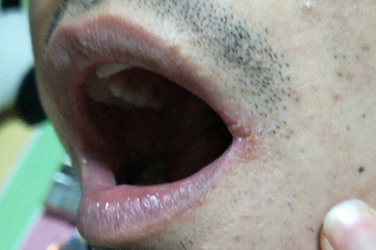 感染性口角炎嘴角发红干燥图