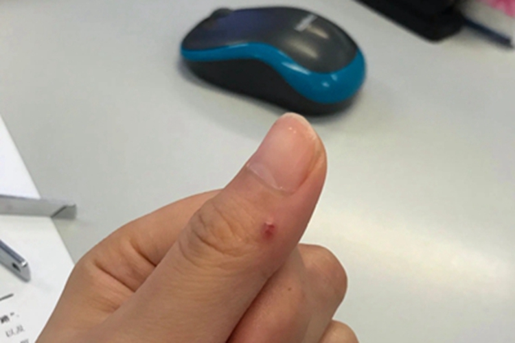 毛发肉芽肿小疙瘩图